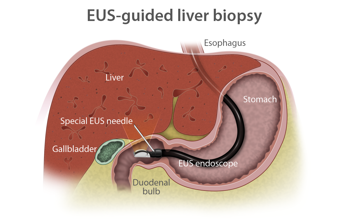 liver-biopsy_revised.png