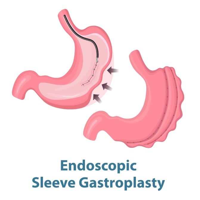 Endoscopic-sleeve-gastroplasty.jpg