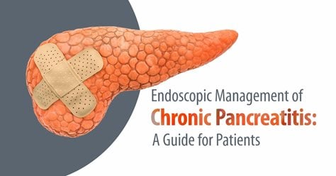 Endoscopic Management of Chronic Pancreatitis: A Guide for Patients