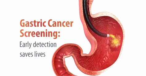 Gastric Cancer Screening: Early Detection Saves Lives