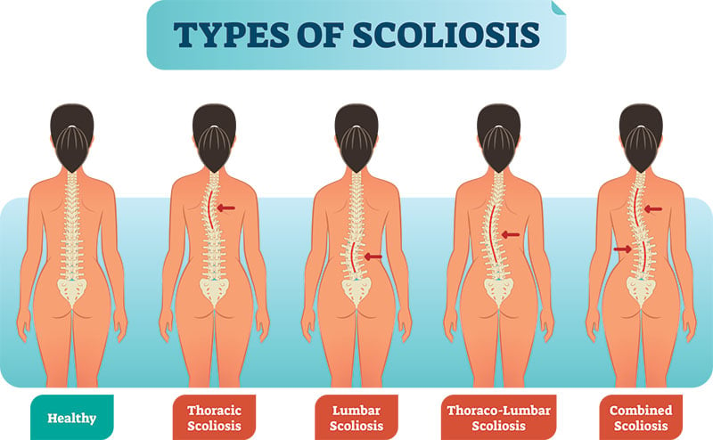 Sleeping with Scoliosis  Scoliosis Therapy Centers