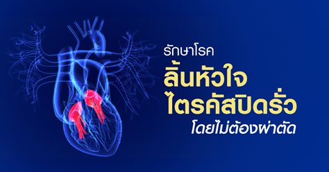 รักษาโรคลิ้นหัวใจไตรคัสปิดรั่วโดยไม่ต้องผ่าตัด