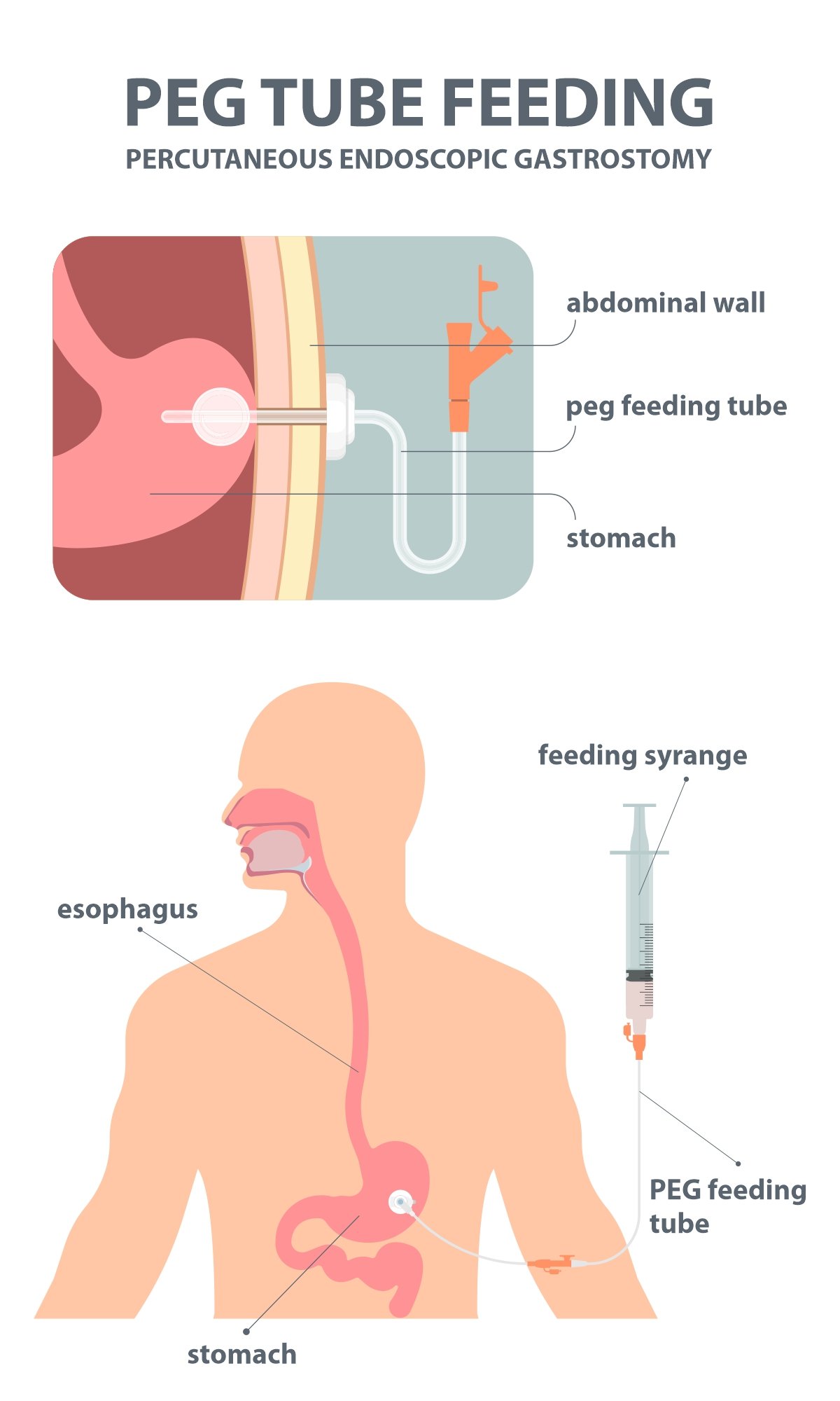 Gastrostomy-3-(1).jpg