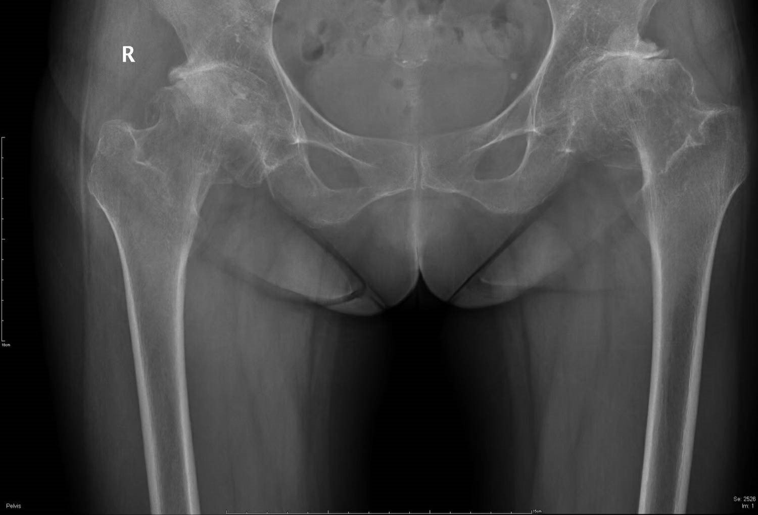 01_hip-osteoarthritis-(2).jpg