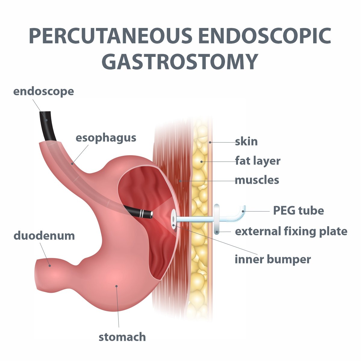 Gastrostomy-4-(2).jpg