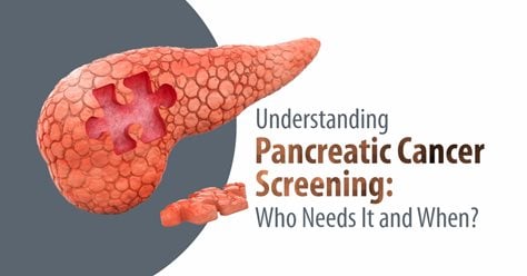 Pancreatic Cancer Screening: Who Needs It and When?