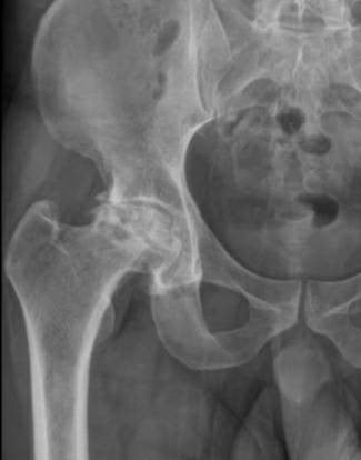 04_hip-osteoarthritis-(1).jpg