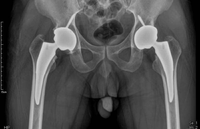 06_hip-osteoarthritis.jpg