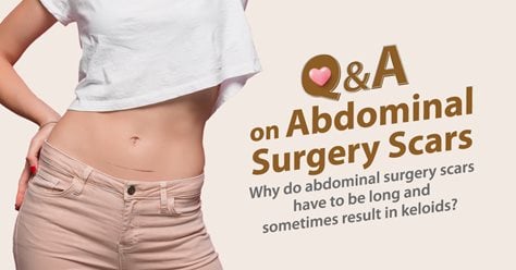 Q&A on Abdominal Surgery Scars